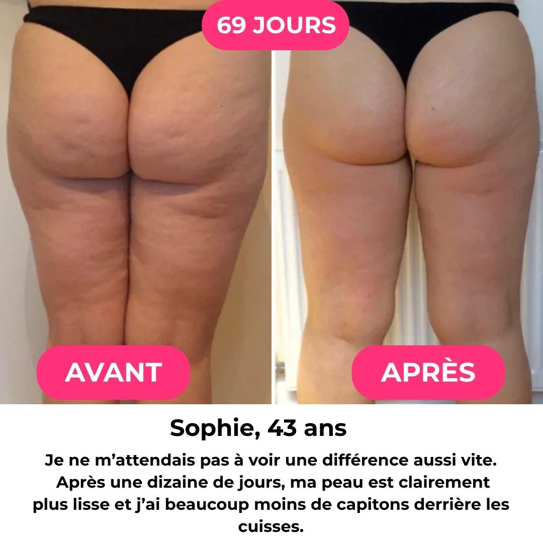 BodyLift™  - Masseur Anti-Cellulite 3-en-1