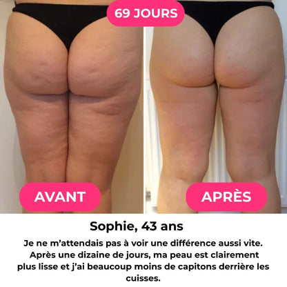 BodyLift™  - Masseur Anti-Cellulite 3-en-1