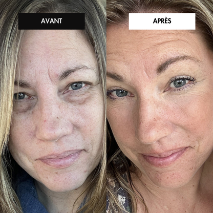 Revital’Eyes™ – Soin Lumière Rouge Anti-Âge & Cernes