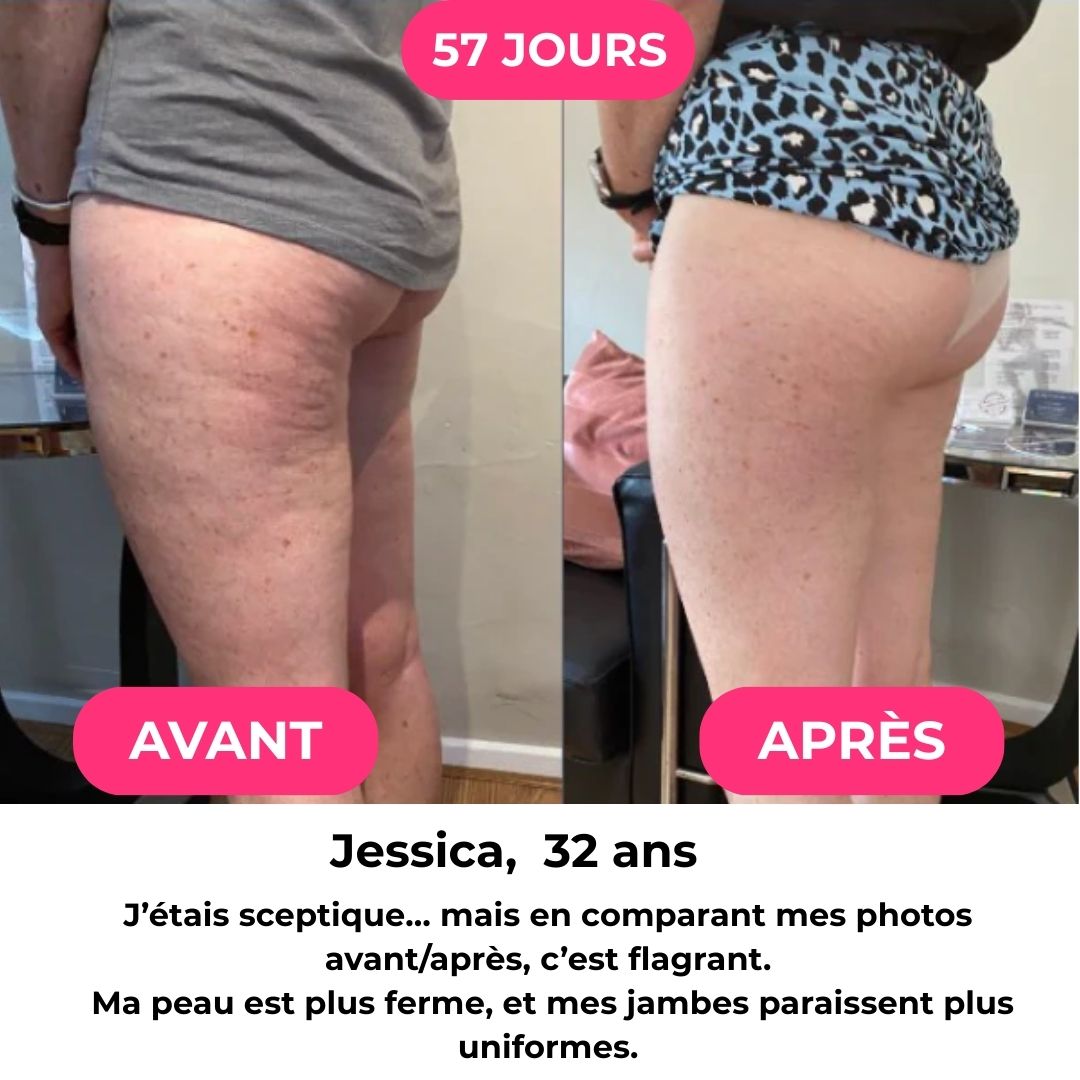 BodyLift™  - Masseur Anti-Cellulite 3-en-1